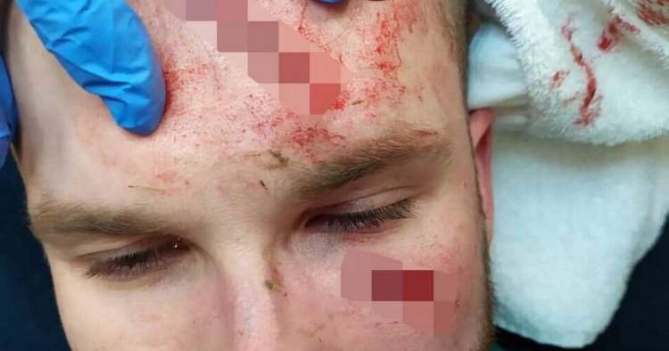 Slavia Prague keeper shows off gruesome injury after Roofe horror challenge
